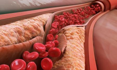 Problema – aukštas cholesterolis: dietologė pataria, kokie maisto produktai gali padėti jį sumažinti