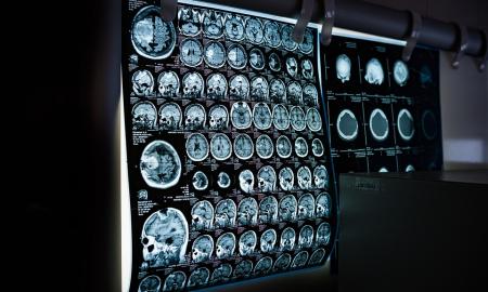Ištyrė mirusius nuo COVID-19: skelbiama, kuriuos organus pažeidžia labiausiai
