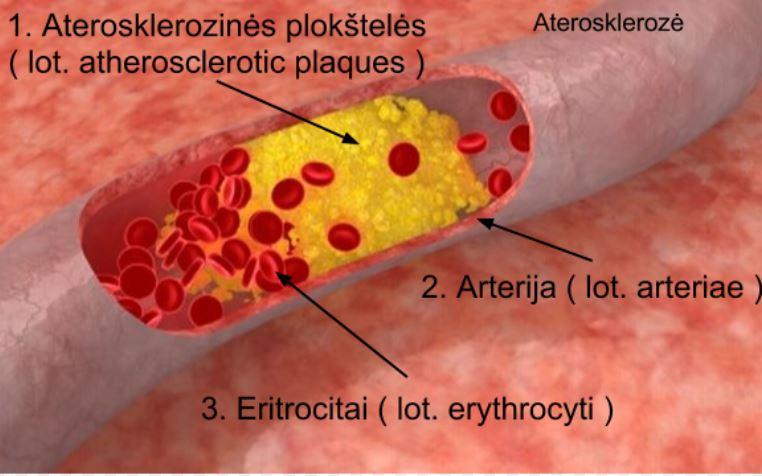 Aterosklerozė