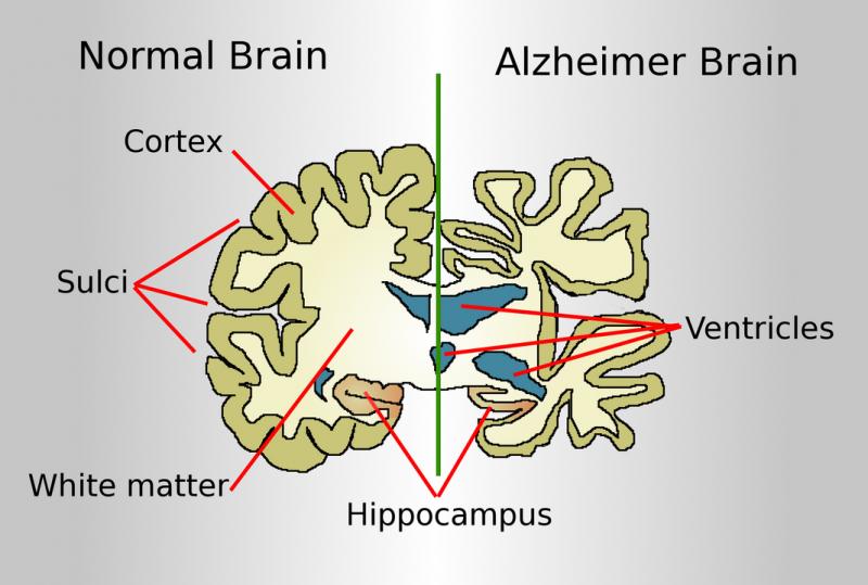 Alzheimerio ligos pažeistos smegenys