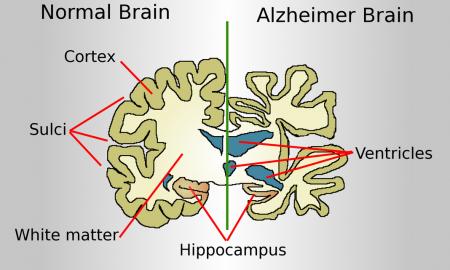 „Šventasis Gralis Alzheimerio ligai.“ Pagaliau. Tik 1 tabletė per dieną