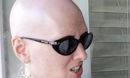 [ŽT] Naujas plikimo gydymo būdas (Foto)