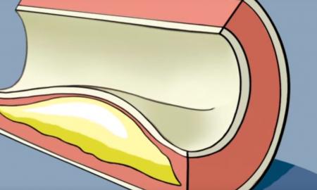 Jie du mėnesius vartojo po šaukštą kasdien. Tada pamatavo cholesterolio kiekį