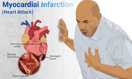 Ką daryti, kai jaučiate, kad tuoj ištiks širdies smūgis? Kelios minutės gali pakeisti jūsų gyvenimą