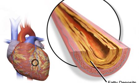 Jie atkemša kraujagysles. Tai natūrali apsauga nuo aterosklerozės 