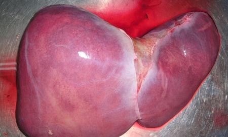 Aptiktas netikėtas kepenų žudikas: štai kas „stingdo“ jūsų organą