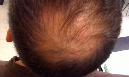 Mokslininkai šokiruoti: naujas metodas plikimą stabdo 500 % efektyvumu – rezultatai matomi greitai