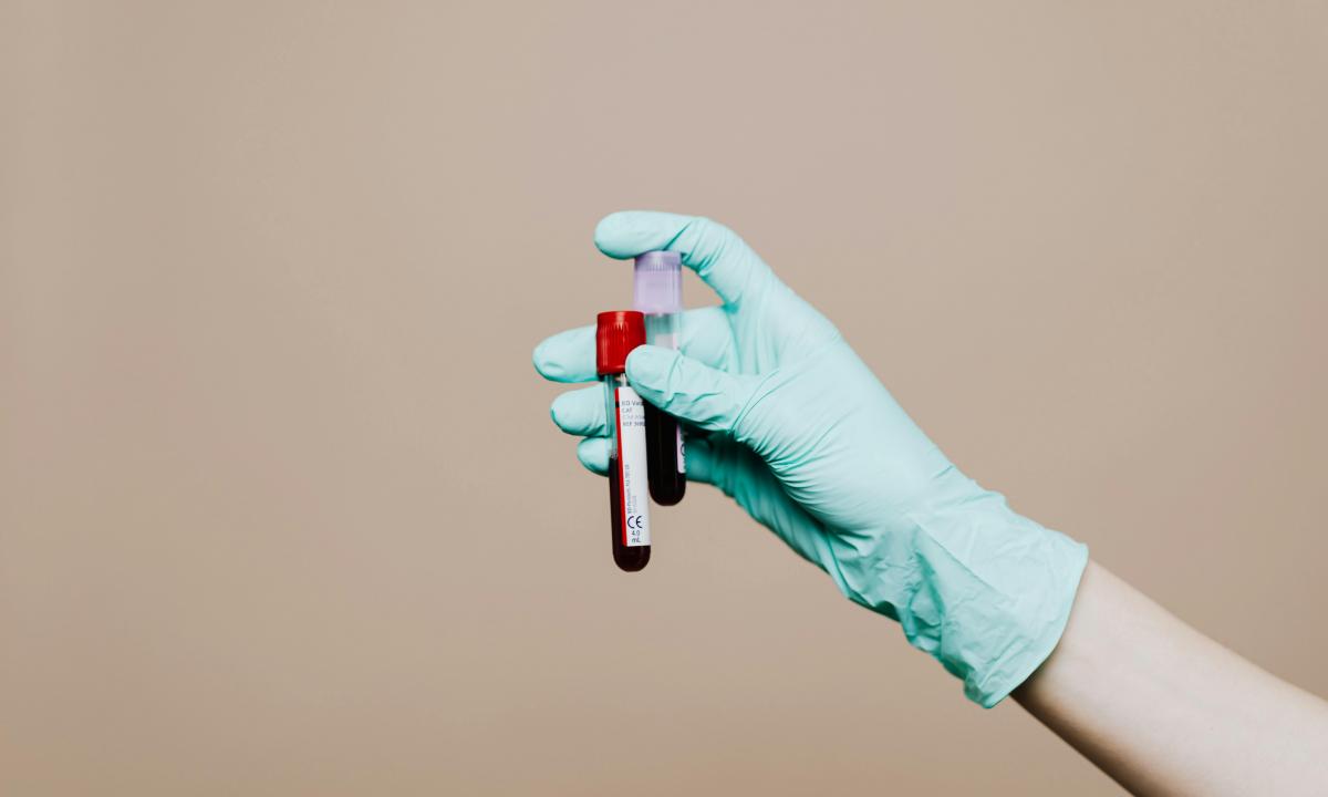 Netikėta tyrimo išvada: „blogasis“ cholesterolis apsaugo nuo klastingos ligos