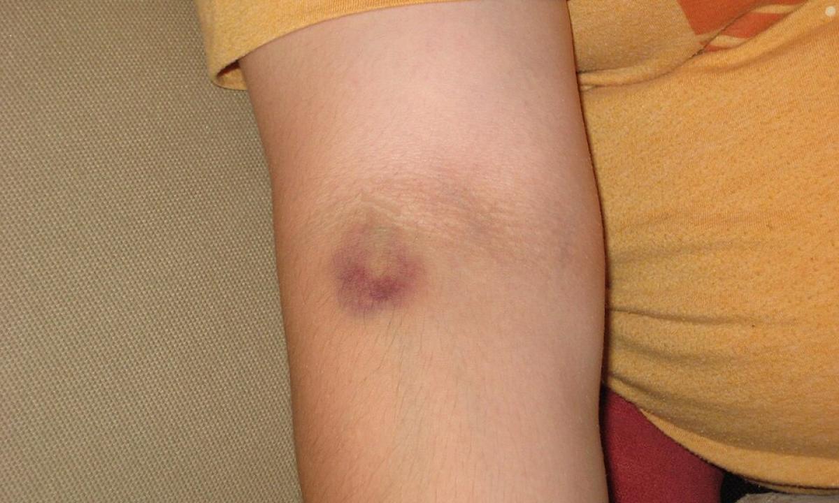 Ant kūno atsirado mėlynės? Trys svarbiausi požymiai, jog tai ne paprastas sumušimas, o rimta liga ir reikia skubiai pas gydytoją